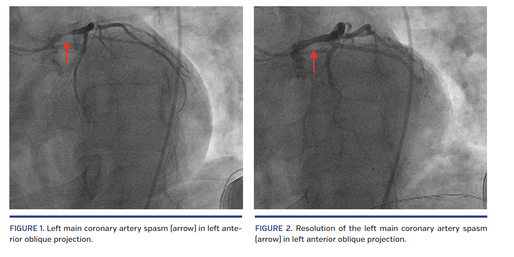 CatheterInduced Coronary Spasm Serious But Preventable